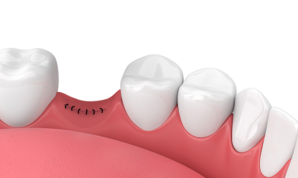 Наложение швов во рту Наложение швов во рту