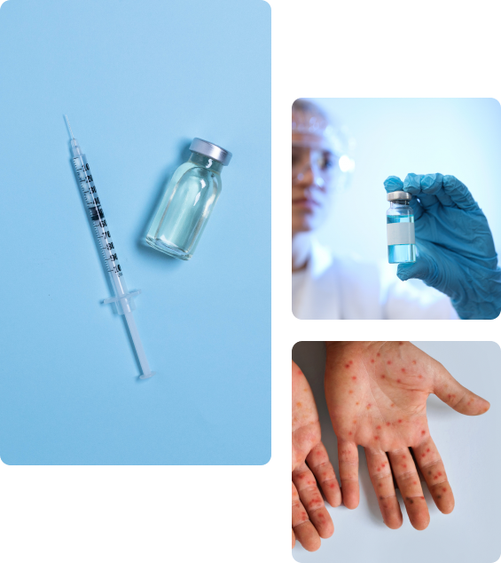 Осложнения после прививки от кори Осложнения после вакцинации от кори