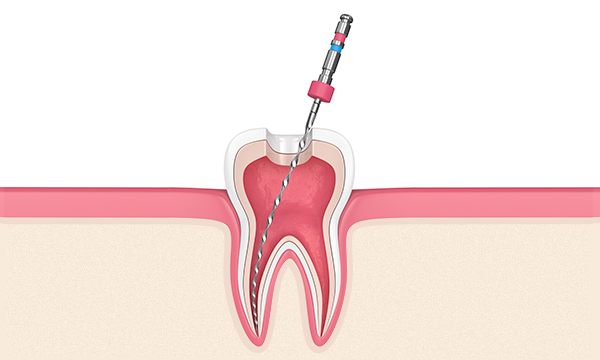 Обработка корневого канала