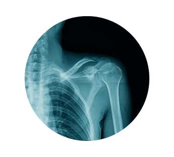 Рентген лопатки Рентген лопатки