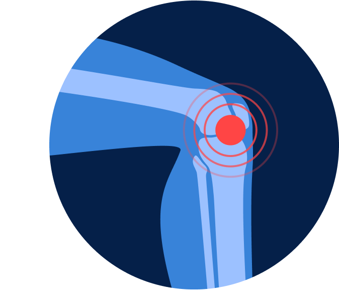 УЗИ коленного сустава УЗИ коленного сустава
