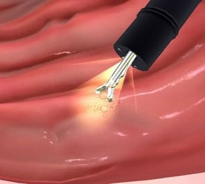 Биопсия Биопсия