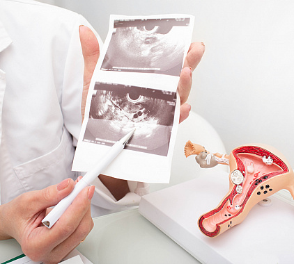 УЗИ яичников УЗИ яичников