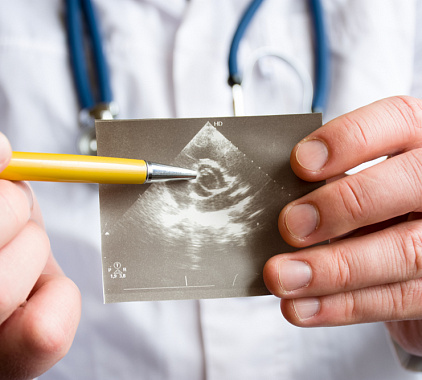 УЗИ брюшной аорты УЗИ брюшной аорты