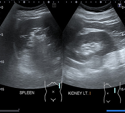 УЗИ селезенки УЗИ селезенки