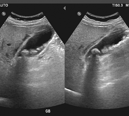 УЗИ мочевого пузыря УЗИ мочевого пузыря